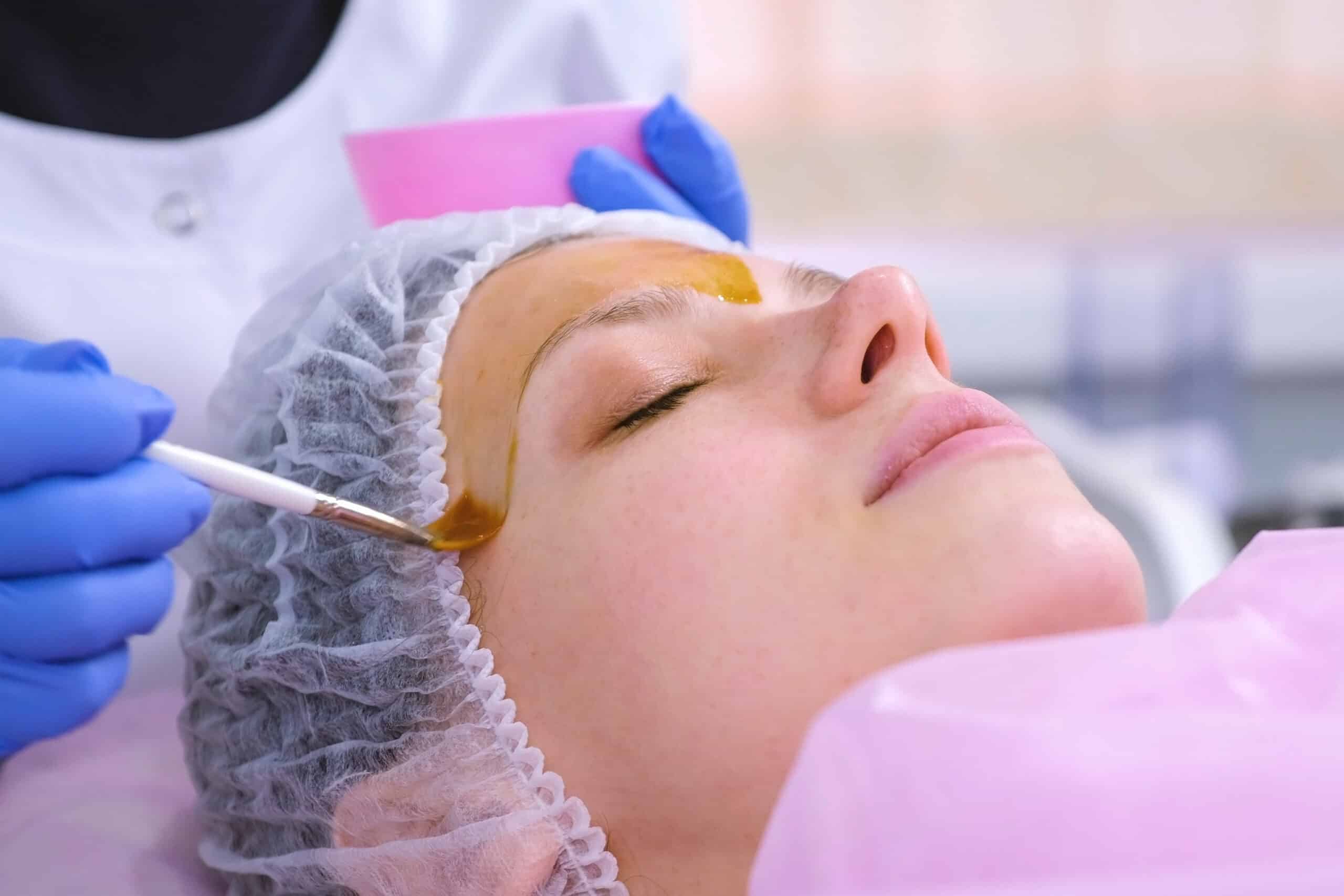 Chemical Peels: Unlocking Radiant Skin