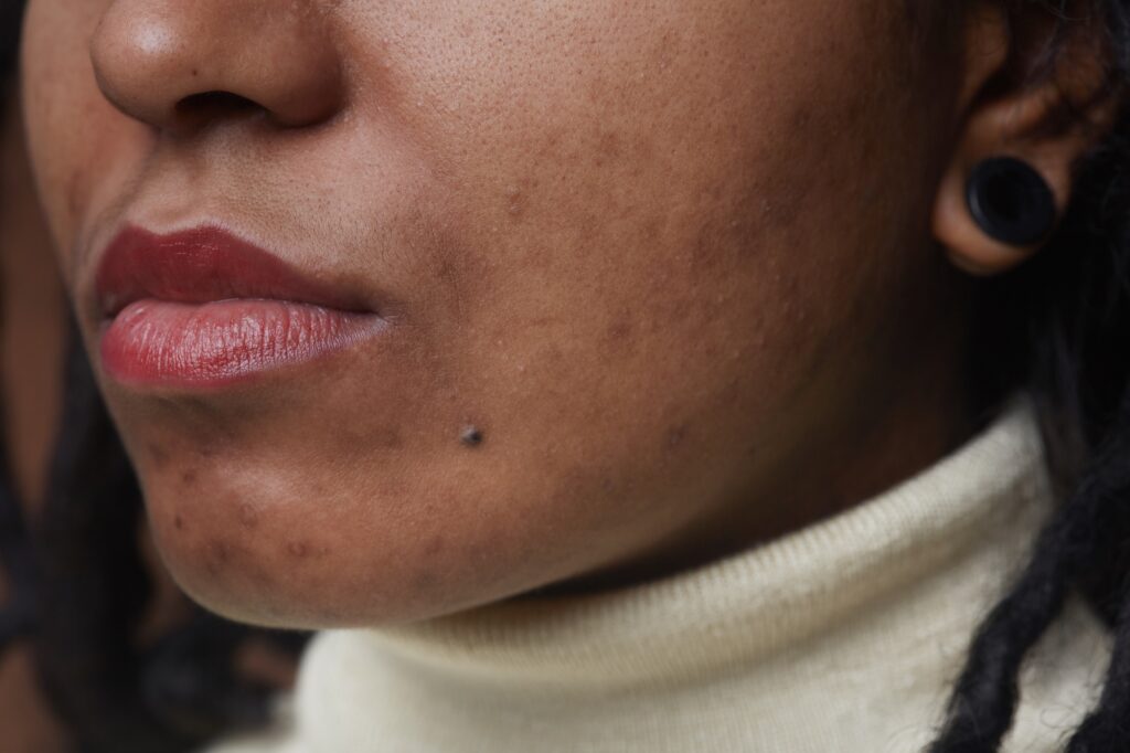Extreme close up portrait of real African American woman with post acne spots and skin imperfections