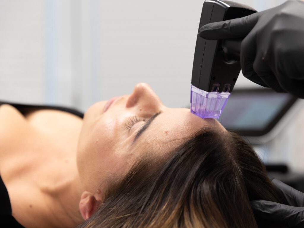 Woman lying down with Microneedle on her forehead.