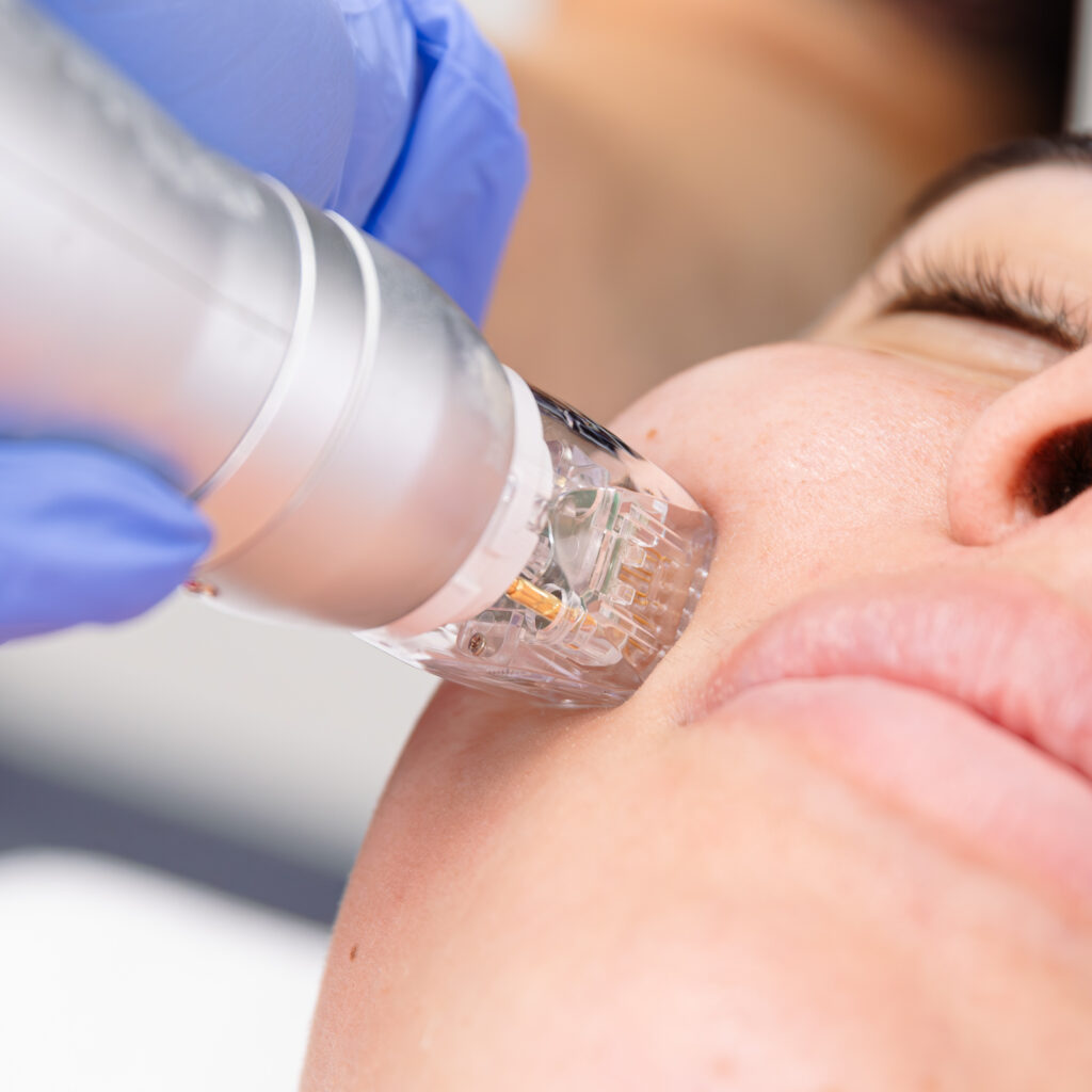 Close-up of microneedle on woman's face.