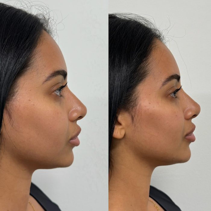 Before and after full face photo #9