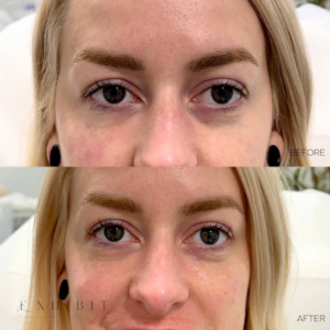 Before and after photos of undereye filler #2