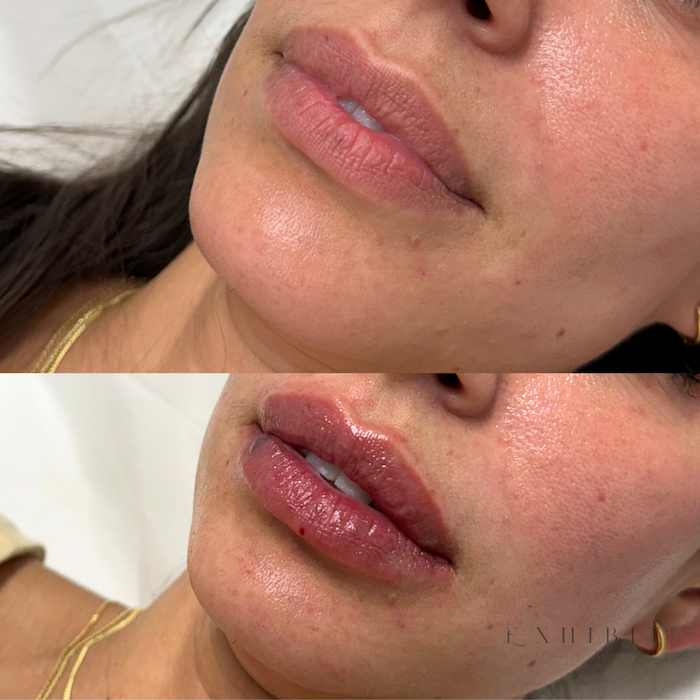 Before and after photo of lip filler #3