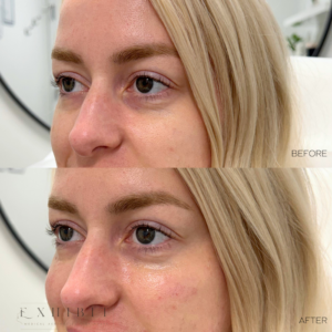 Before and after photos of undereye filler #2