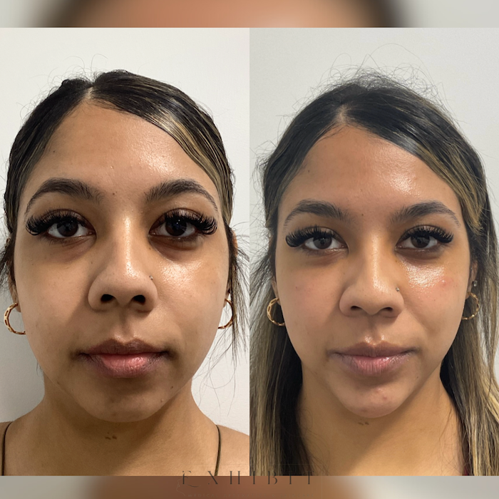 Before and after photos of undereye filler 3