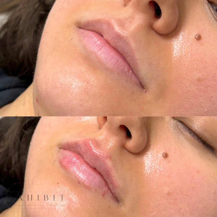 Before and after photo of lip filler #5