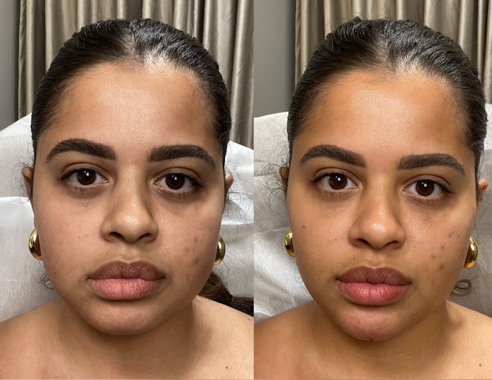 Before and after full face photo #3