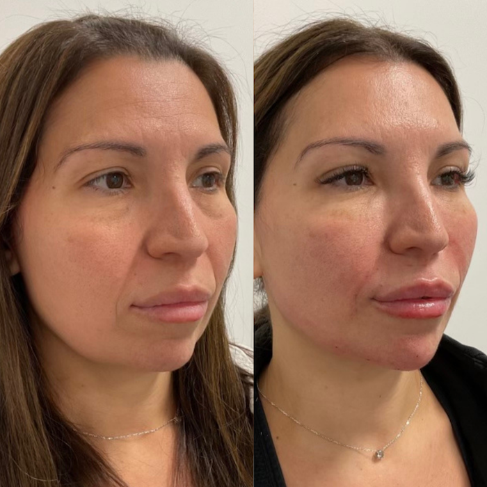 Before and after full face photo #5