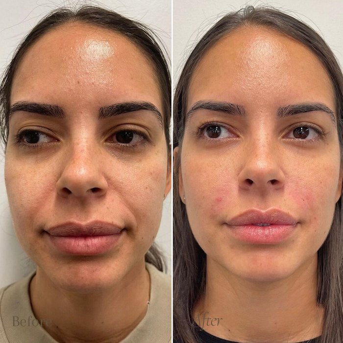 Before and after full face photo #6