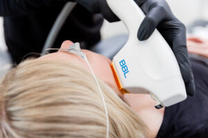 A woman in our clinic after learning how to reduce facial fat in Denville