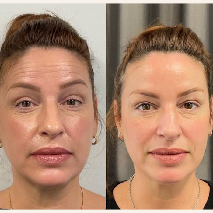 Before and after photo of Botox