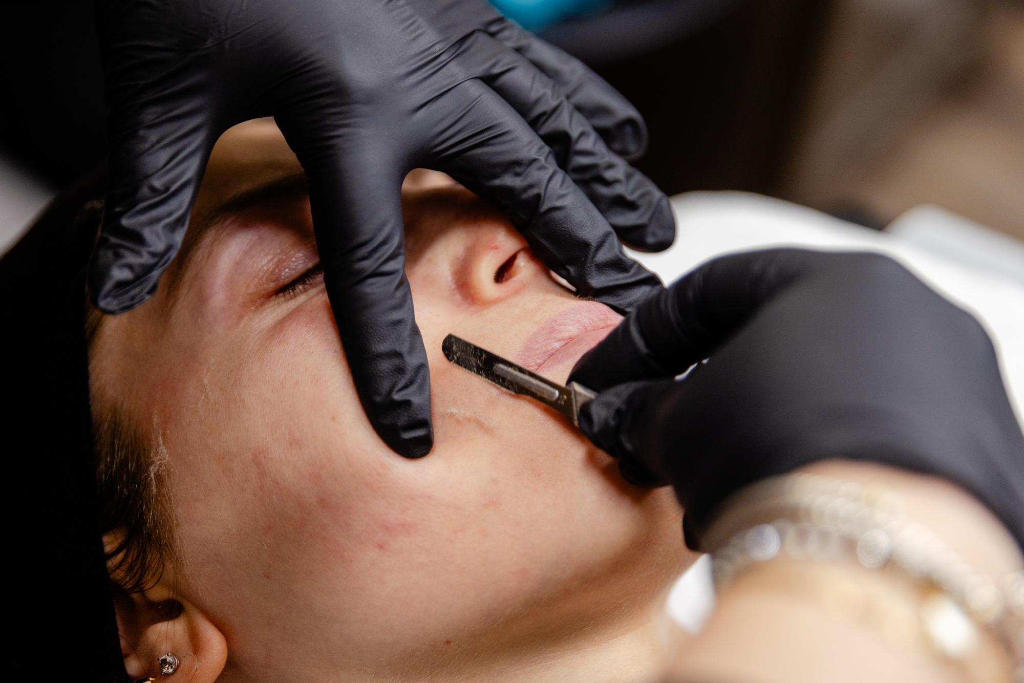 Nurse wearing gloves dermaplanes patient's face