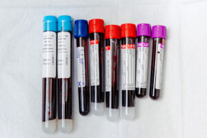 Vials of blood used for PRP injections in Morris County, NJ