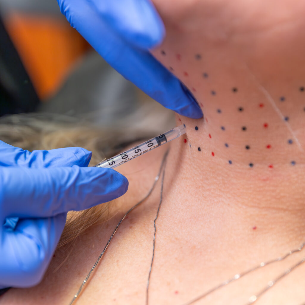 Close-up of needle inserted into lower neck, with dots marking the skin.