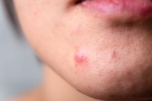 girl with acne that could be treated with a skincare routine in Denville.
