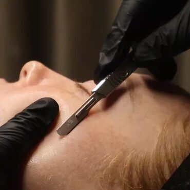 A profile shot of a woman receiving dermaplaning near Mountain Lakes, NJ