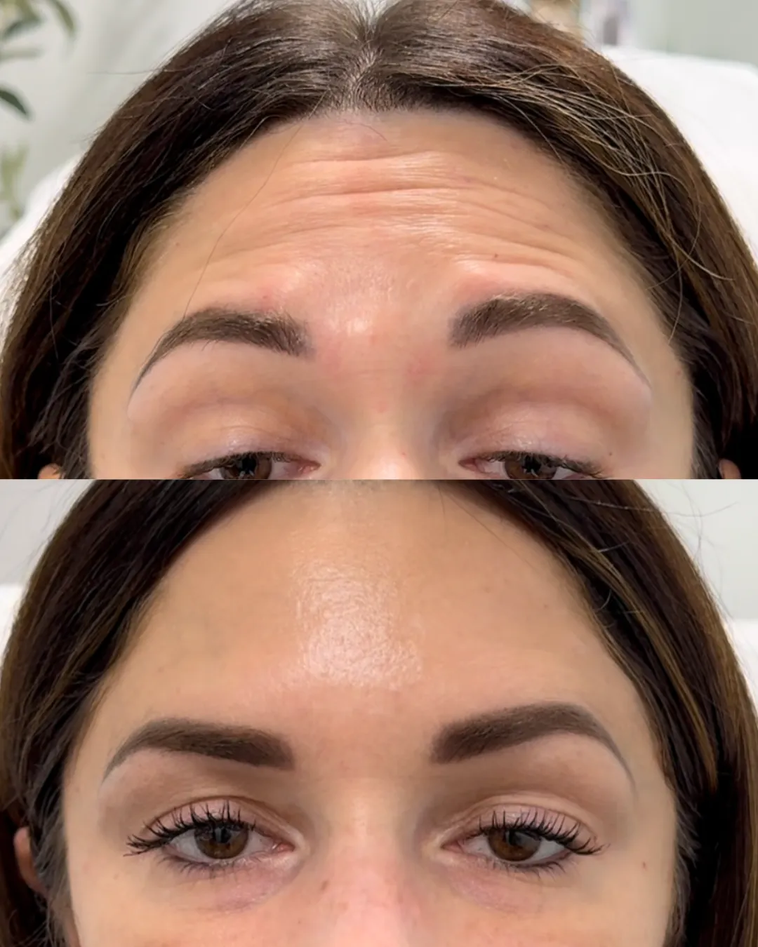 Daxxify Injections in Denville, NJ
