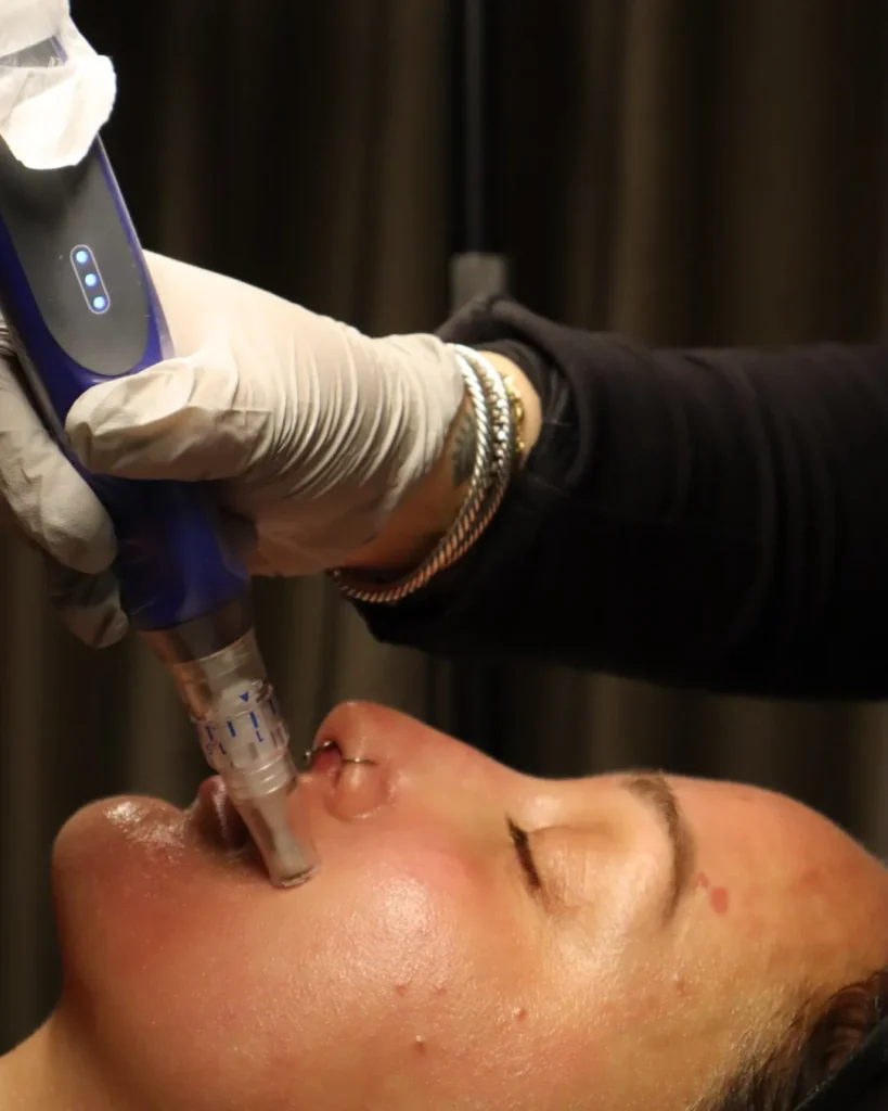 Microneedling in Denville, NJ