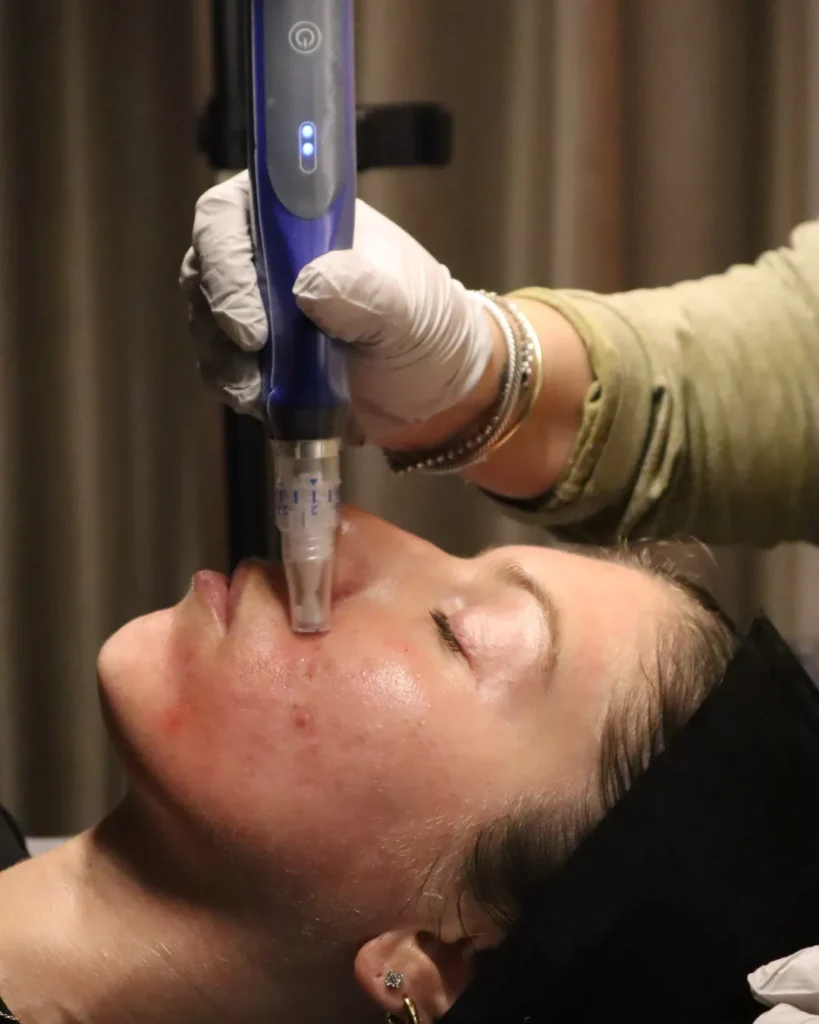Microneedling in Denville, NJ