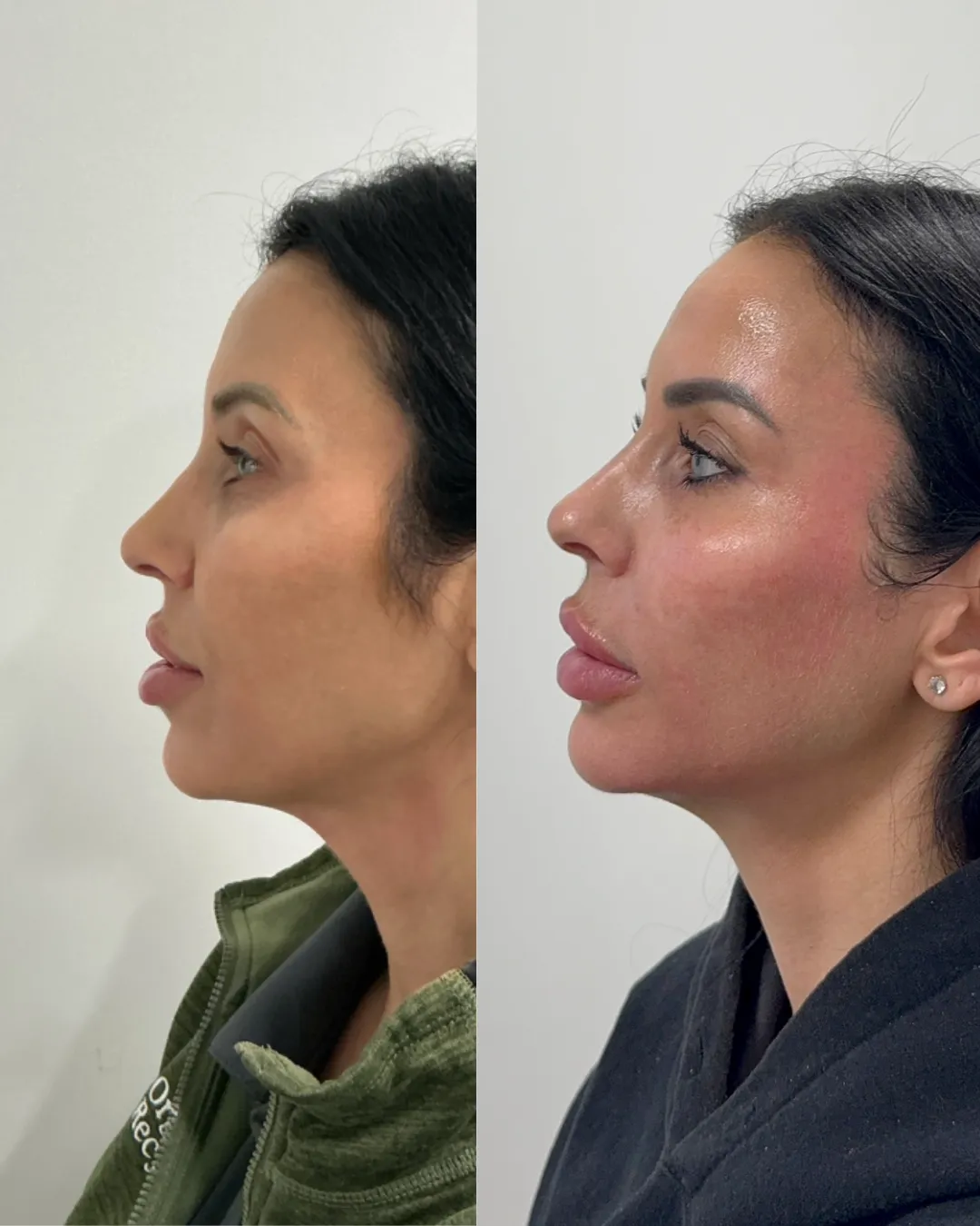 Sculptra in Denville, NJ